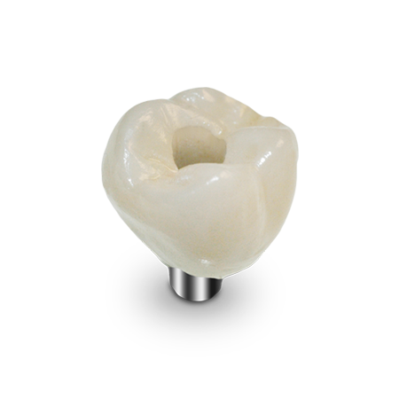 Screw-Retained Crown Thumbnail